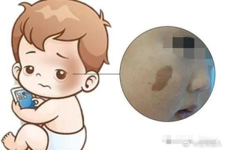 胎记算命图解：什么是红胎记？