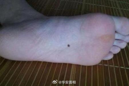 痣相风水脚底有痣的人命运好不好