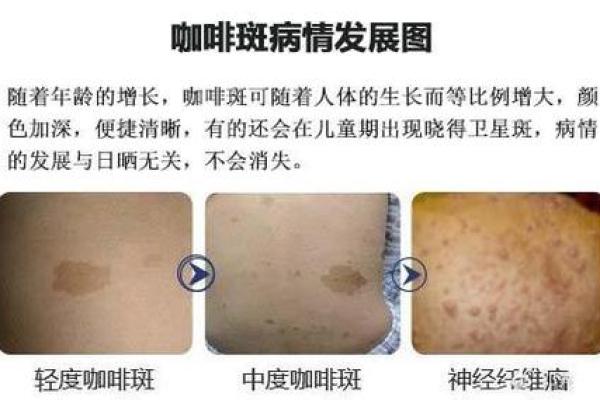 不同部位的胎记算命分析