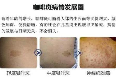 不同部位的胎记算命分析