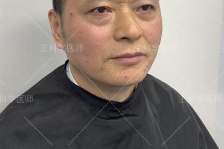 八字眼袋