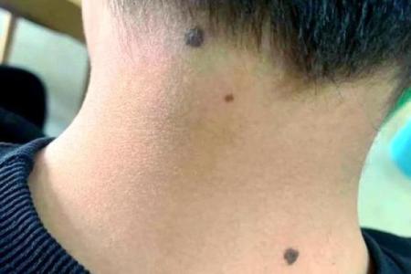 脖子痣看相算命吉凶